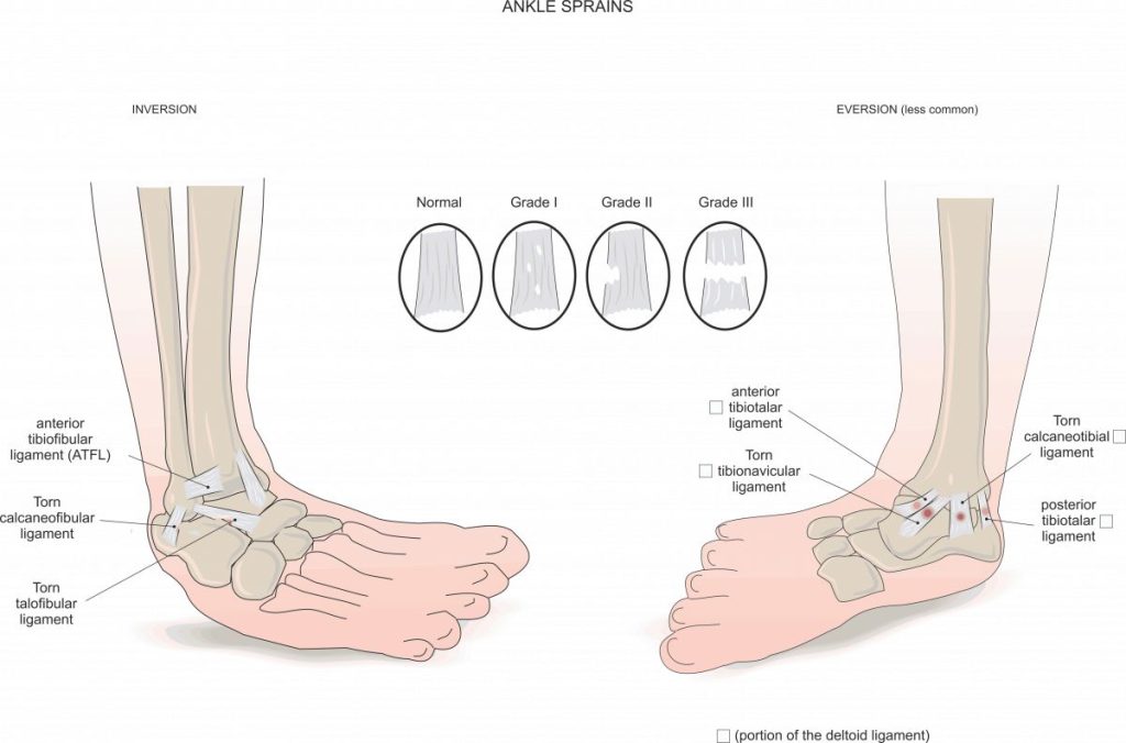 Inversion eversion ankle sprain anatomy 1200x792 1