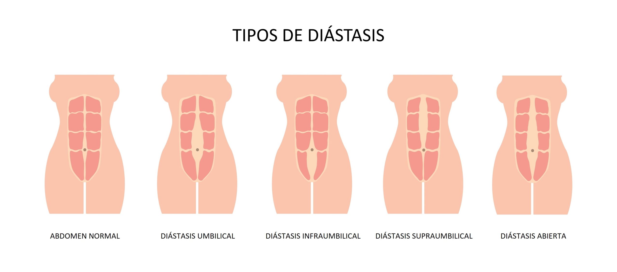 Tipos diastasis EstudioFisio scaled