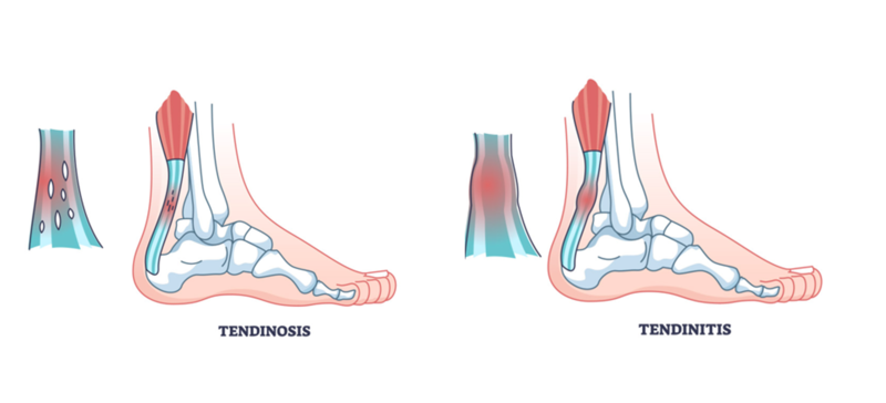 tendinosis vs tendinitis